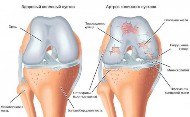 Болезни бронхов: симптомы и лечение