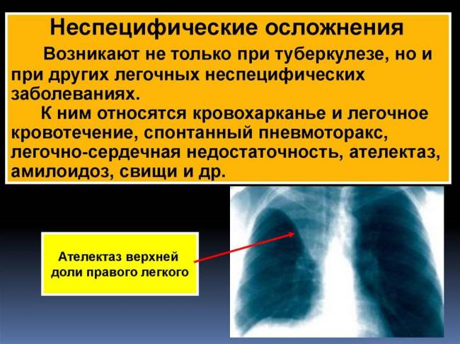 Первые признаки туберкулеза легких у женщин и мужчин
