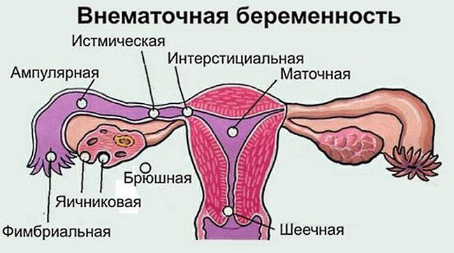 Беременность эктопическая (ectopic pregnancy), беременность внематочная (extrauterine pregnancy)