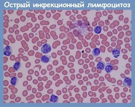 Повышены лимфоциты в крови — что это значит у женщин?