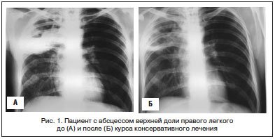 Туберкулез это рак легких или нет