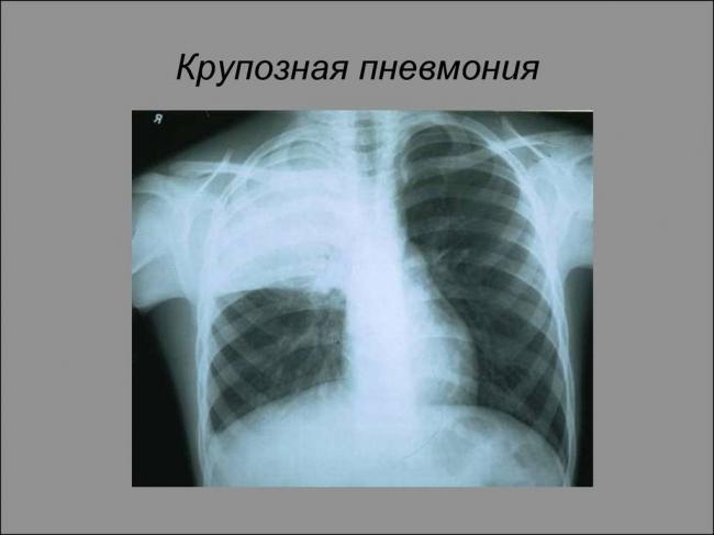Пневмония: симптомы у взрослых, лечение и профилактика