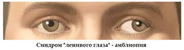 Косоглазие у новорожденных: 5 видов, способы лечения, видео