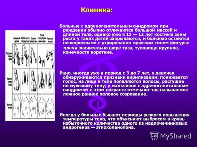 Адреногенитальный синдром