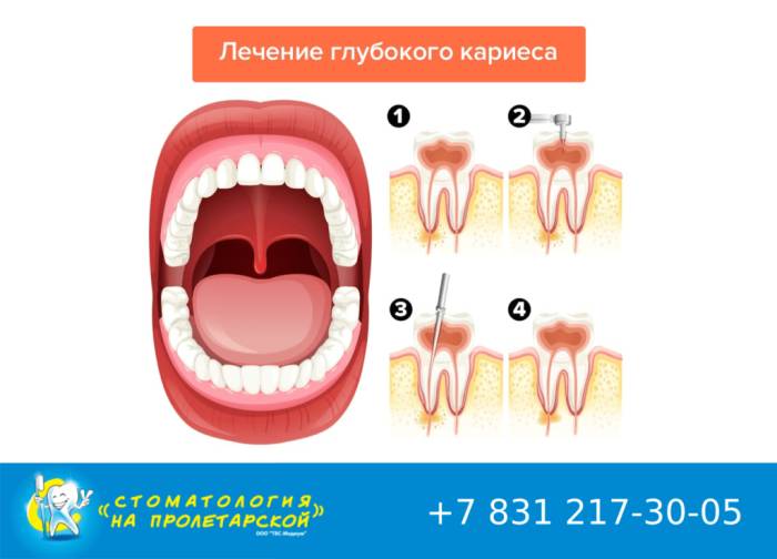 Пломбирование зубов: особенности и виды зубных пломб