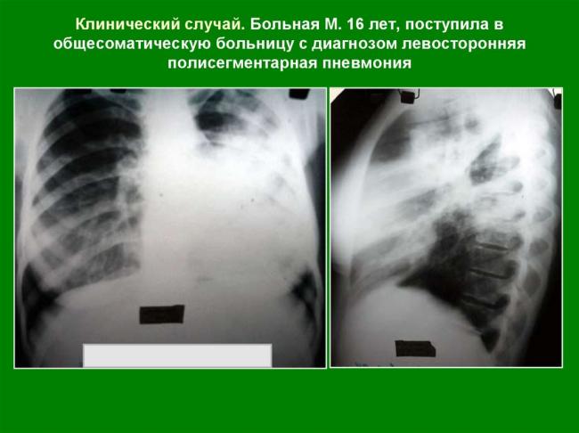 Самые эффективные антибиотики для лечения туберкулеза