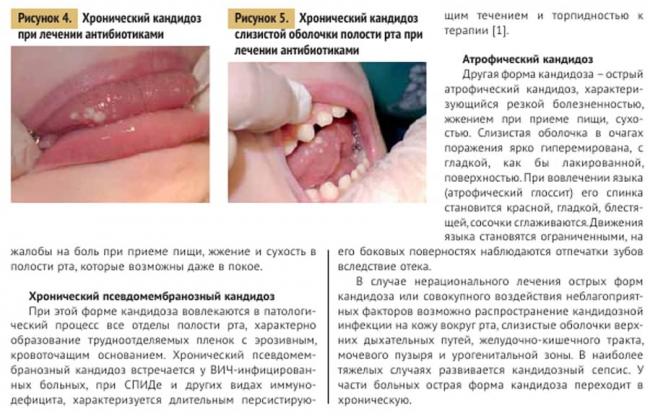 Глоссит: виды, симптомы и лечение