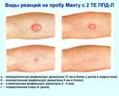 Почему нельзя мочить манту, и сколько дней ее нельзя мочить?