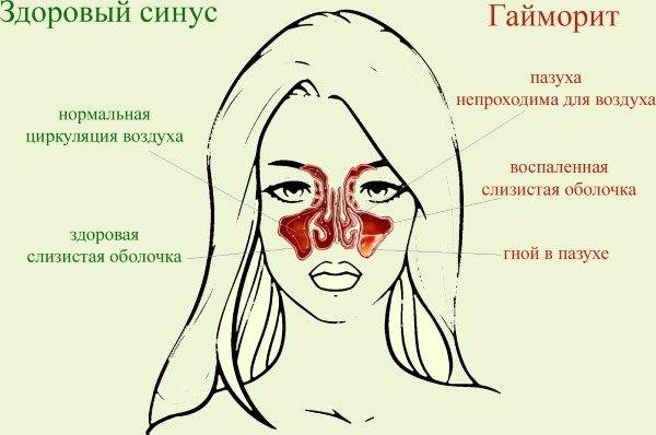 Правила и особенности промывания носа при насморке
