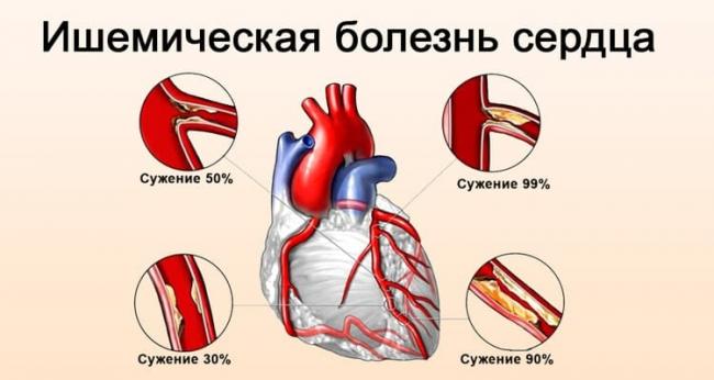 Лечебное питание при ишемической болезни сердца