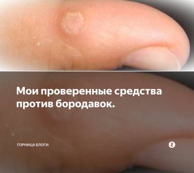 Какие причины появления бородавок на теле?