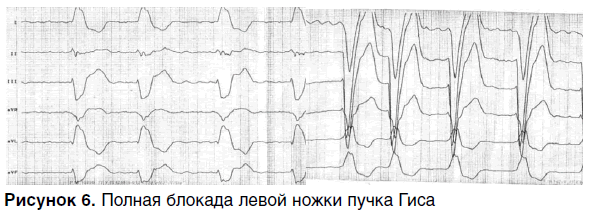 Блокада ножек пучка гиса