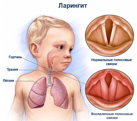 Кашель во время физических нагрузок у ребенка