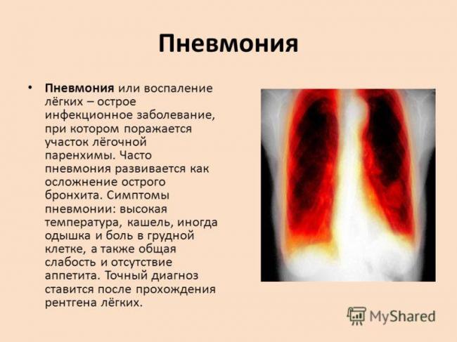 Как распознать пневмонию у детей при отсутствии повышенной температуры