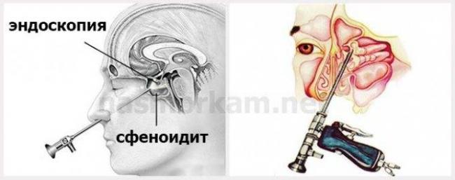 Острый и хронический пансинусит: признаки и лечение в домашних условиях