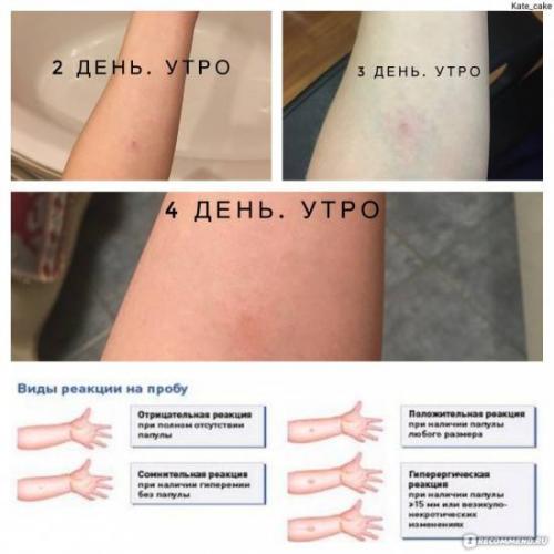 Можно ли делать диаскинтест при простуде, кашле или насморке?