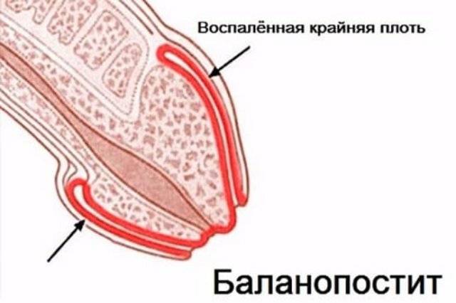 Возникли волдыри на члене? от чего они проявляются их виды и лечение