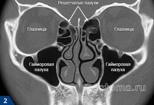 Сфеноидит — его симптомы и лечение