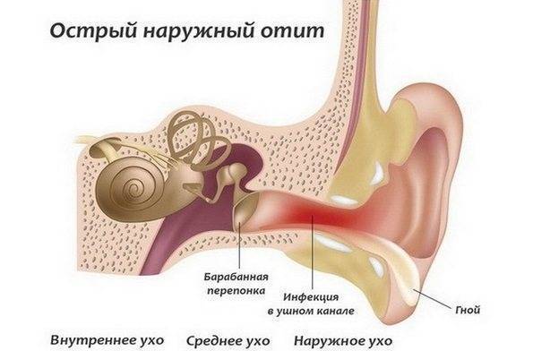 Болят уши при простуде: чем лечить в домашних условиях