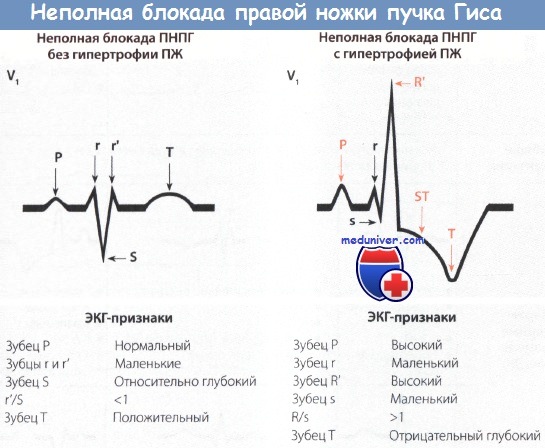 Блокада правой ножки пучка гиса: причины и симптомы, чем это опасно, лечение и прогноз