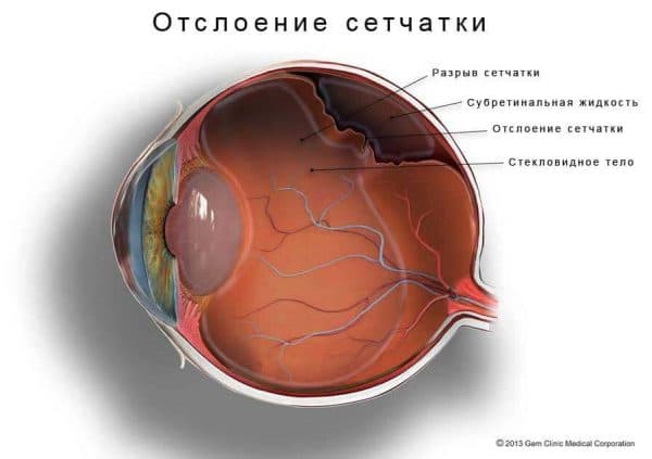 Народные средства лечения деструкции стекловидного тела