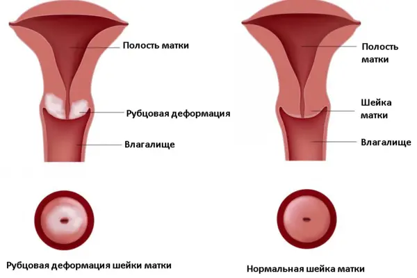 Болезни тела и шейки матки у женщин