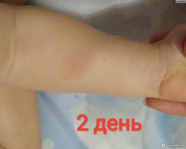 Реакция манту у ребенка