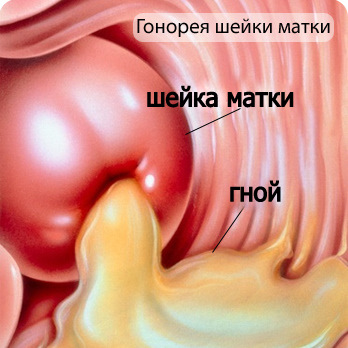 Температура при гонорее