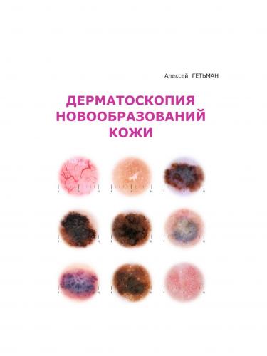 Как отличить опасные и неопасные родинки на теле человека