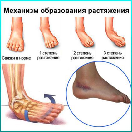 Растяжение связок коленного сустава — лечение, причины и симптомы