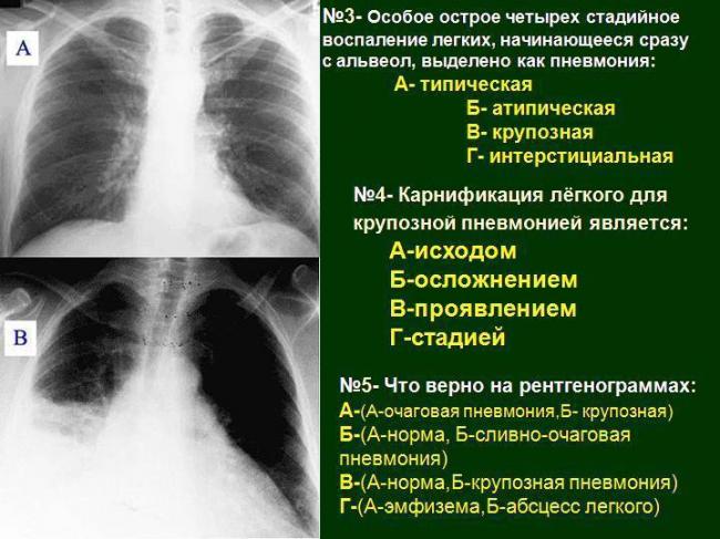 Лечение крупозной пневмонии у детей. какие стадии течения у заболевания?