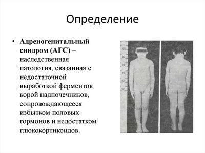 Адреногенитальный синдром – сольтеряющая, вирильная, постпубертатная форма у девочек, у мальчиков. диагностика, лечение адреногенитального синдрома