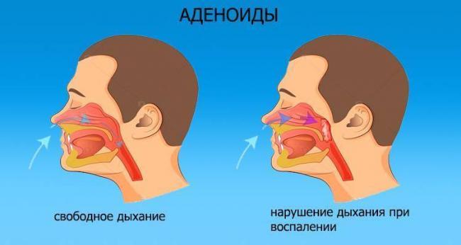 Заложенность носа без насморка: причины и лечение взрослого