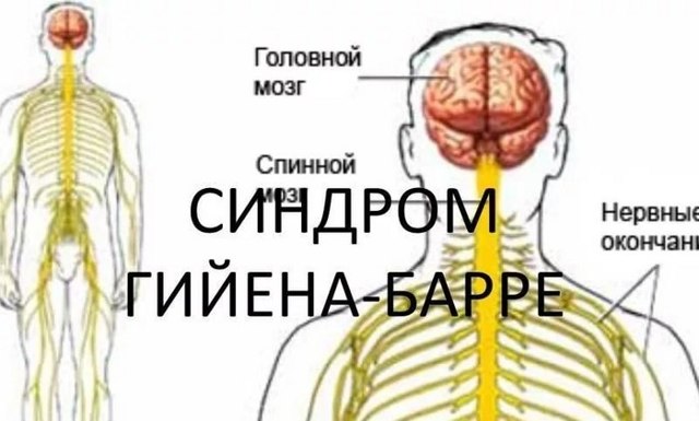 Синдром гийена-барре
