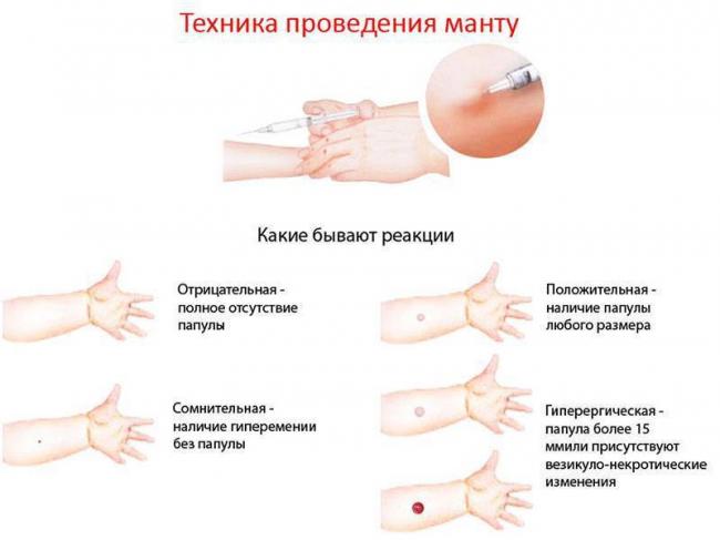 Что такое реакция манту и какая она должна быть