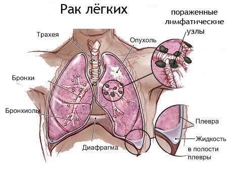 Чем отличается туберкулез от рака легких на снимках