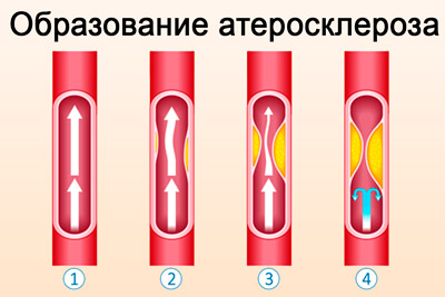 Как действует элтацин