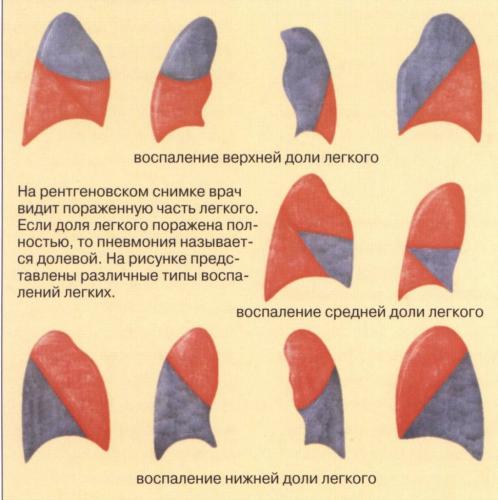 Сколько держится температура при пневмонии
