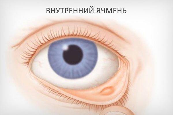 Как правильно лечить ячмень во время беременности
