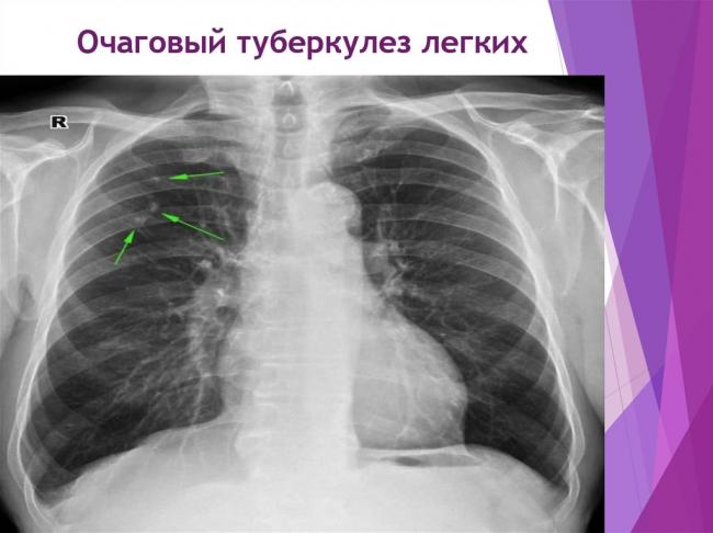 Как правильно питаться при туберкулезе: витамины и минералы