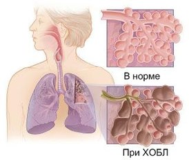 Хобл – что это такое, как лечится? хроническая обструктивная болезнь легких – симптомы, лечение, продолжительность жизни