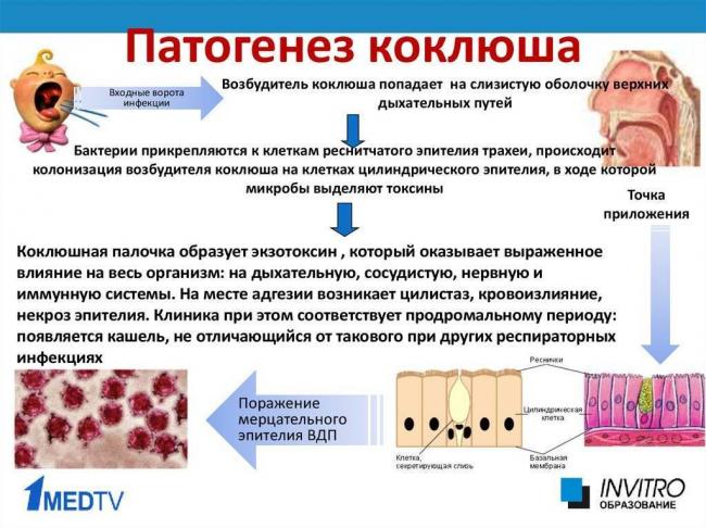 Коклюш - симптомы болезни, профилактика и лечение коклюша, причины заболевания и его диагностика на eurolab