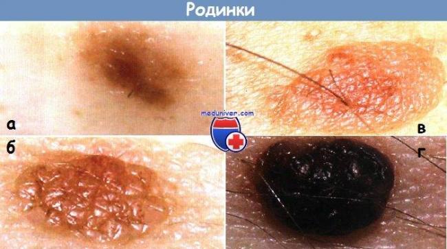Опасные родинки: 6 признаков меланомы