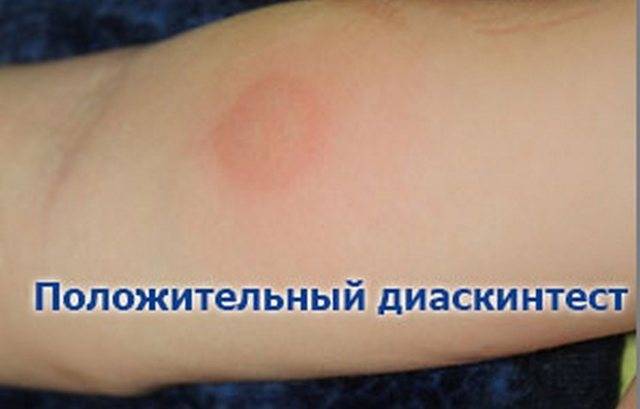 Что такое диаскинтест и противопоказания делать детям