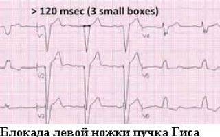 Неполная блокада правой ножки пучка гиса - экг