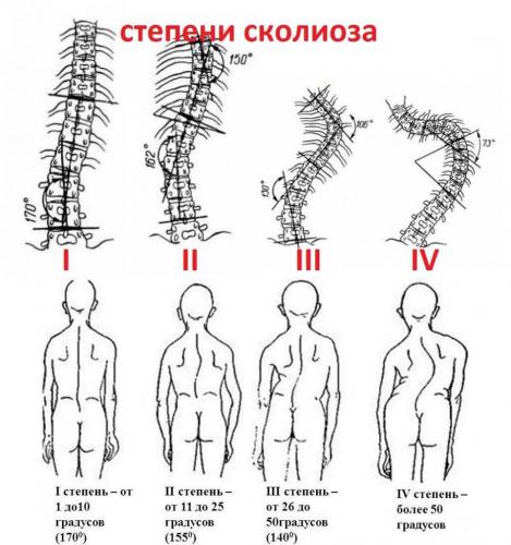 Комплекс лфк при сколиозе