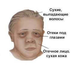 Заболевание гипотиреоз щитовидной железы
