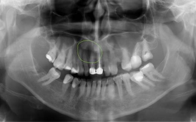 Способы удаления кисты зуба и восстановление десны после операции