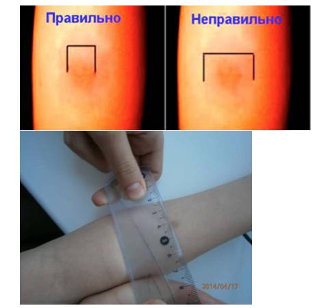Как должна выглядеть нормальная реакция манту