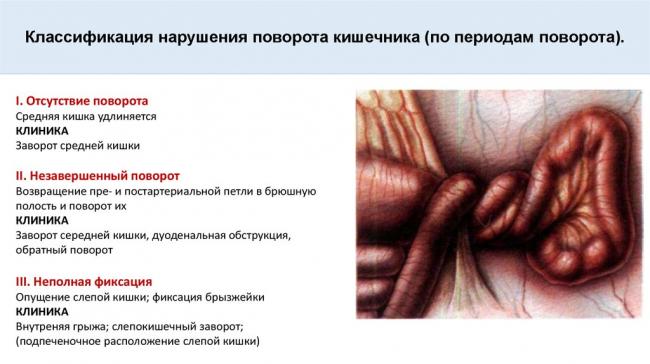 Что можно кушать после операции непроходимость кишечника